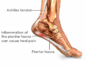 Achilles Tendon Injuries